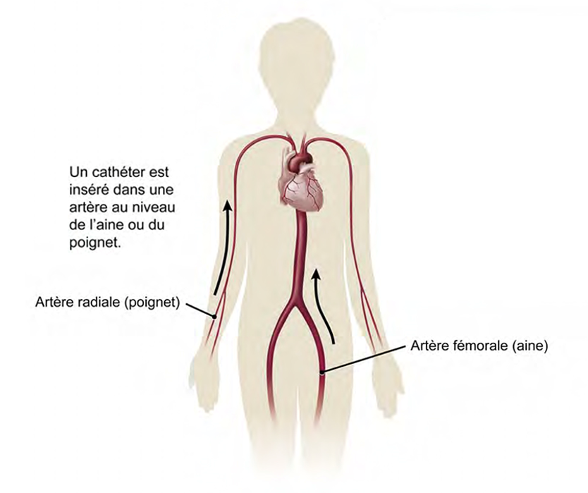Angiographie (Cathétérisme cardiaque) – Institut de cardiologie de  l'Université d'Ottawa